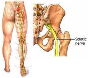 sciatica_1.jpg